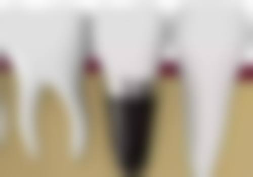 美国3MP60树脂补牙，给你坚固耐用的牙齿