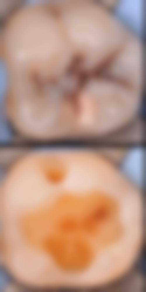 广东东莞中堂恒诺口腔的患者真实反馈